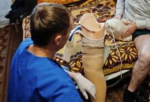 تسبب خطأ طبي ببتر ساق رجل دنماركي. حيث تأخر الأطباء في تشخيص مدى خطورة حالته وفات الأوان بذلك لإنقاذ ساقه ما أدى إلى بترها.